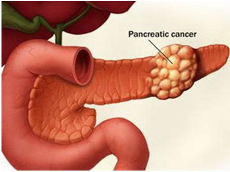 2016年胰腺癌研究及诊疗进展